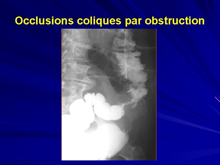 Occlusions coliques par obstruction 