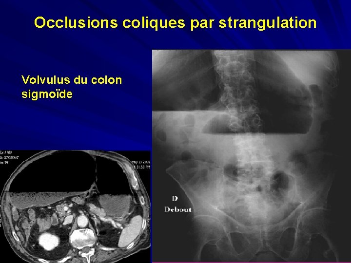 Occlusions coliques par strangulation Volvulus du colon sigmoïde 
