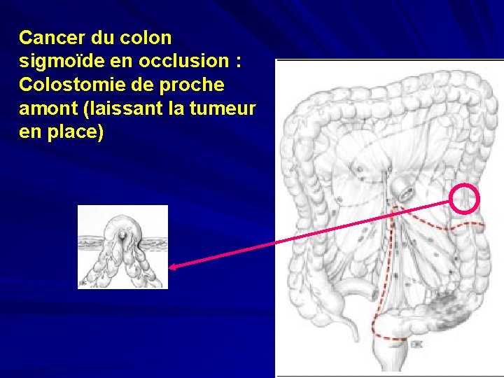 Cancer du colon sigmoïde en occlusion : Colostomie de proche amont (laissant la tumeur