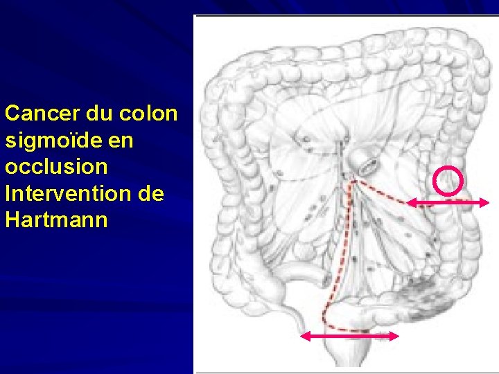 Cancer du colon sigmoïde en occlusion Intervention de Hartmann 