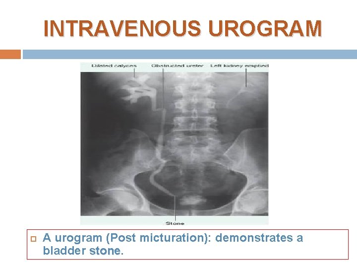 INTRAVENOUS UROGRAM A urogram (Post micturation): demonstrates a bladder stone 