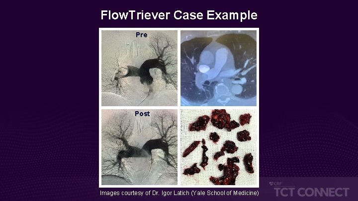 Flow. Triever Case Example Pre Post Images courtesy of Dr. Igor Latich (Yale School