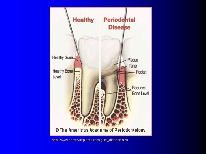 http: //www. cassityimplants. com/gum_disease. htm 