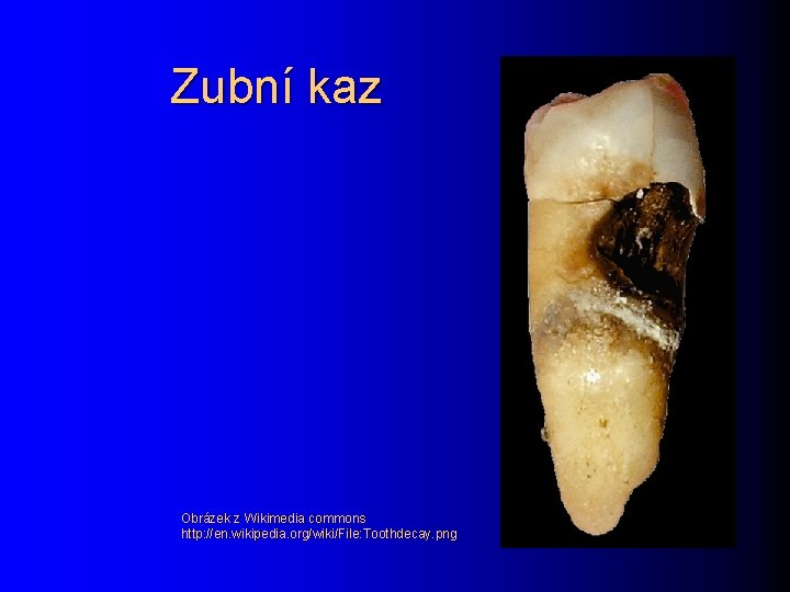 Zubní kaz Obrázek z Wikimedia commons http: //en. wikipedia. org/wiki/File: Toothdecay. png 