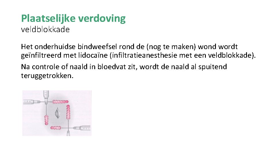 Plaatselijke verdoving veldblokkade Het onderhuidse bindweefsel rond de (nog te maken) wond wordt geïnfiltreerd