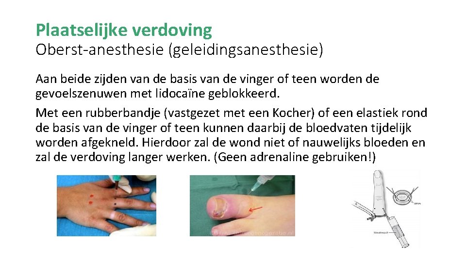 Plaatselijke verdoving Oberst-anesthesie (geleidingsanesthesie) Aan beide zijden van de basis van de vinger of