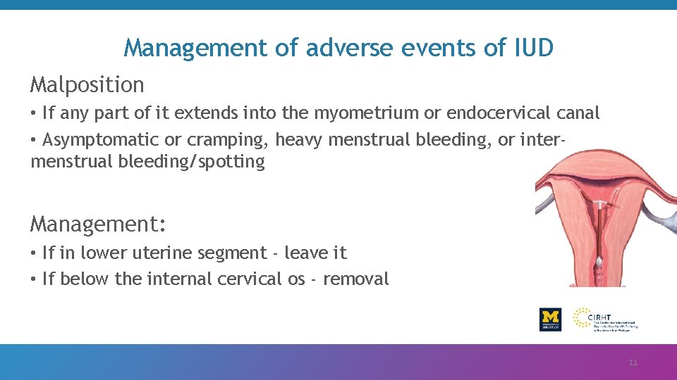 Management of adverse events of IUD Malposition • If any part of it extends