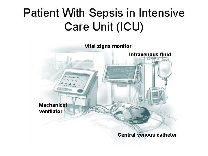 Patient With Sepsis in Intensive Care Unit (ICU) Vital signs monitor Intravenous fluid Mechanical
