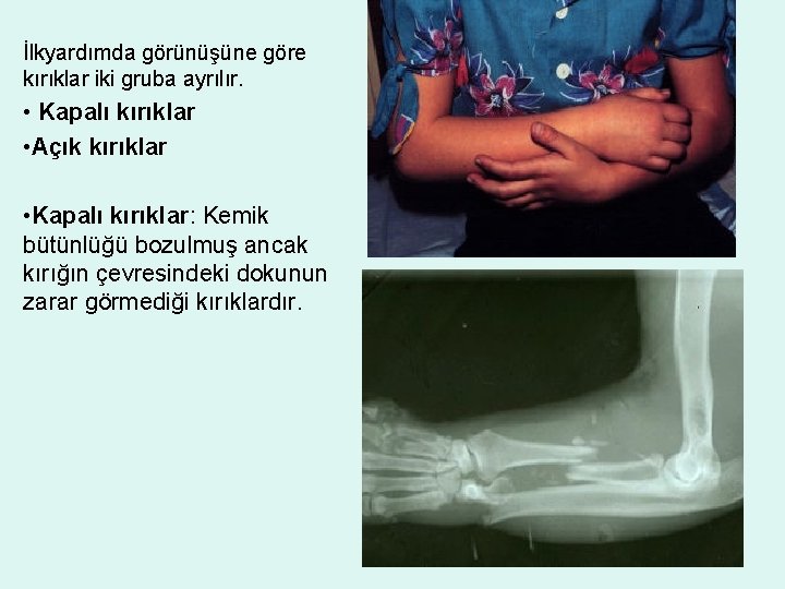 İlkyardımda görünüşüne göre kırıklar iki gruba ayrılır. • Kapalı kırıklar • Açık kırıklar •