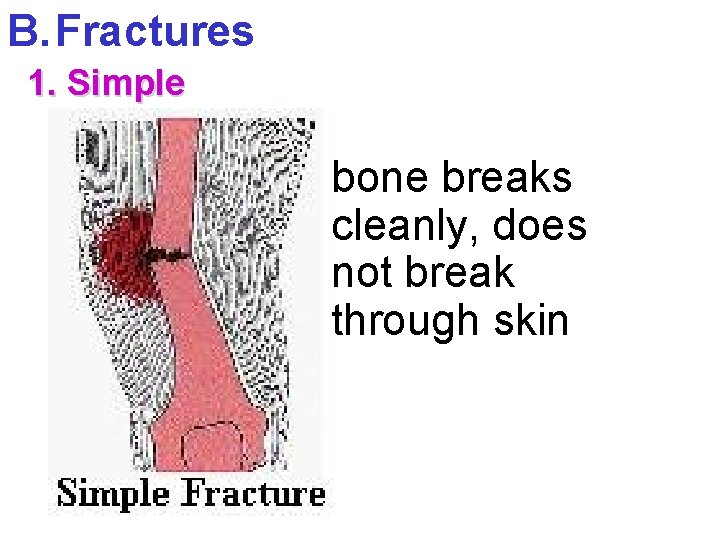 B. Fractures 1. Simple bone breaks cleanly, does not break through skin 