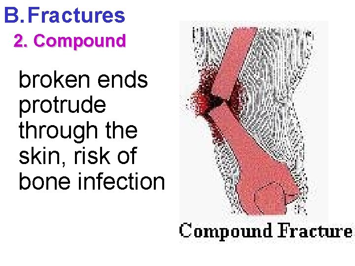 B. Fractures 2. Compound broken ends protrude through the skin, risk of bone infection