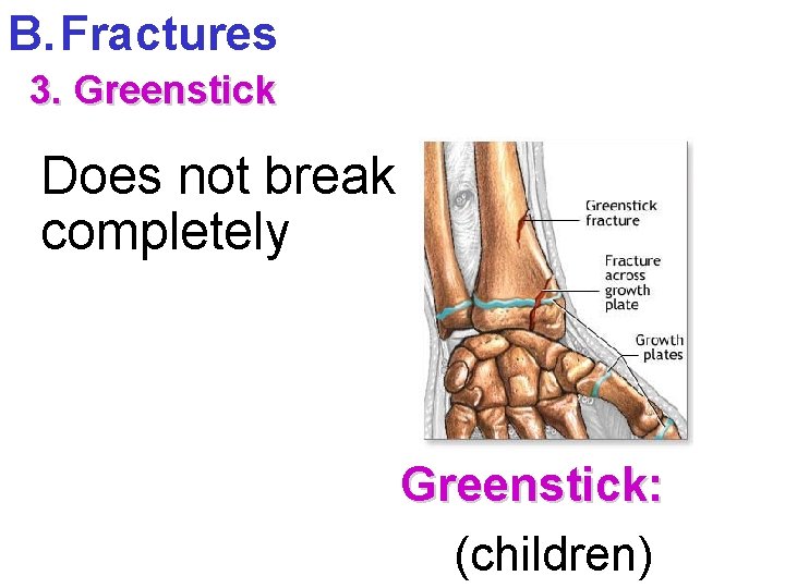 B. Fractures 3. Greenstick Does not break completely Greenstick: (children) 