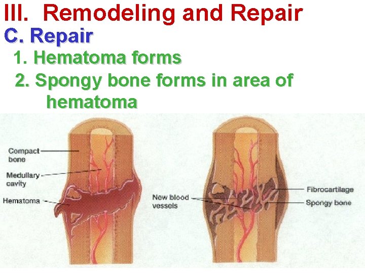 III. Remodeling and Repair C. Repair 1. Hematoma forms 2. Spongy bone forms in