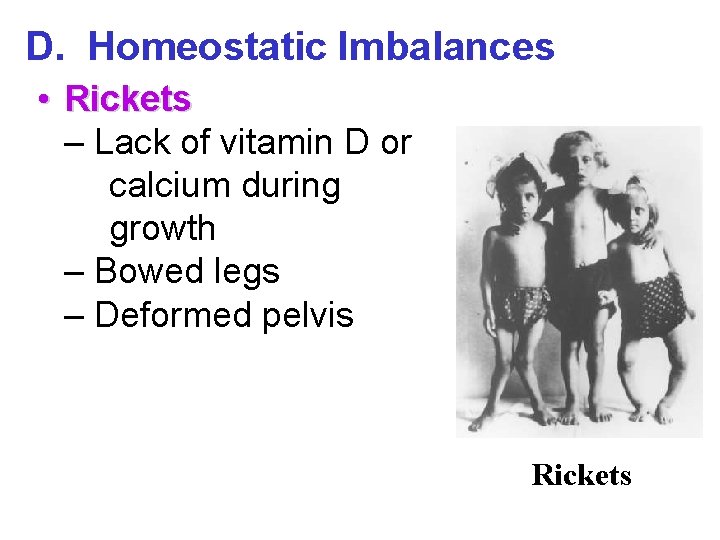 D. Homeostatic Imbalances • Rickets – Lack of vitamin D or calcium during growth