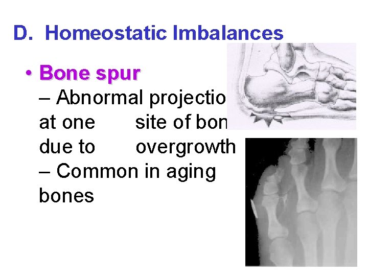 D. Homeostatic Imbalances • Bone spur – Abnormal projection at one site of bone