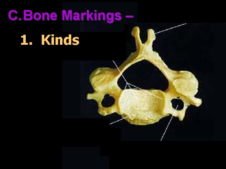 C. Bone Markings – 1. Kinds 