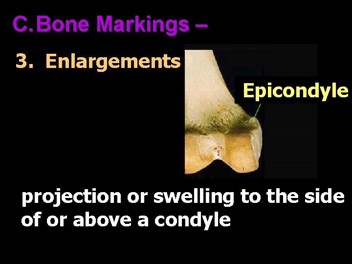 C. Bone Markings – 3. Enlargements Epicondyle projection or swelling to the side of