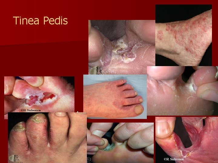 Tinea Pedis Common portal of entry is toe web maceration n 