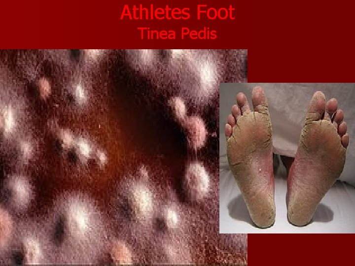 Athletes Foot Tinea Pedis 