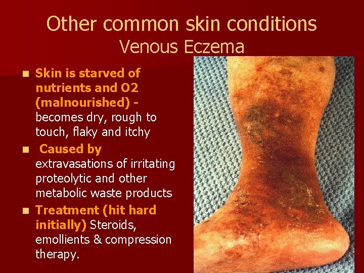 Other common skin conditions Venous Eczema Skin is starved of nutrients and O 2