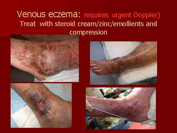 Venous eczema: requires urgent Doppler) Treat with steroid cream/zinc/emollients and compression 
