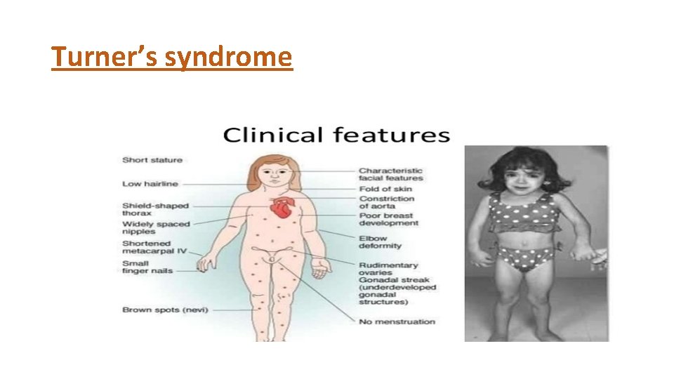Turner’s syndrome 