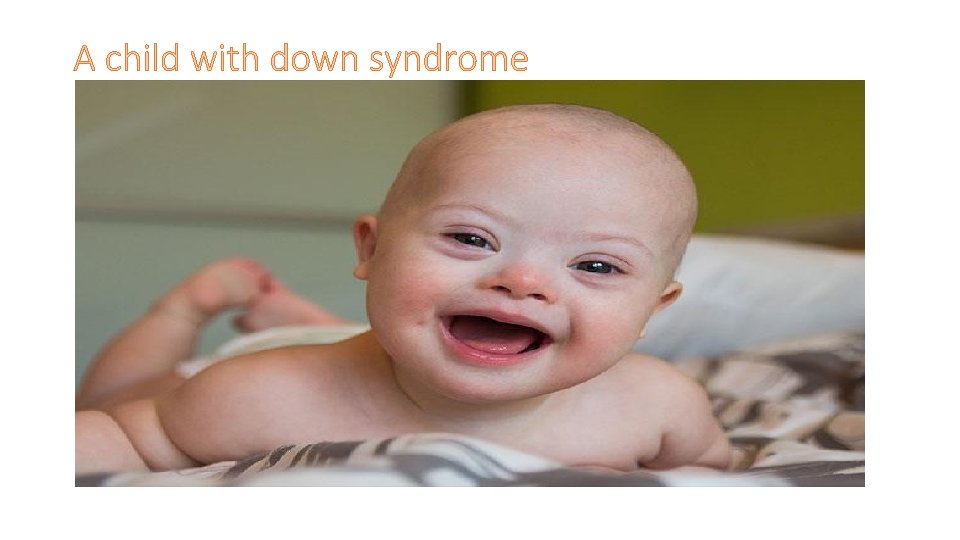 A child with down syndrome 