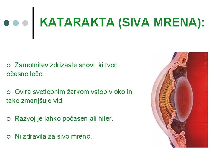 KATARAKTA (SIVA MRENA): Zamotnitev zdrizaste snovi, ki tvori očesno lečo. ¢ Ovira svetlobnim žarkom