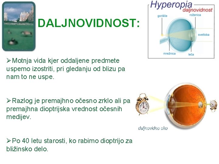 DALJNOVIDNOST: ØMotnja vida kjer oddaljene predmete uspemo izostriti, pri gledanju od blizu pa nam