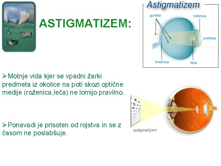 ASTIGMATIZEM: ØMotnje vida kjer se vpadni žarki predmeta iz okolice na poti skozi optične