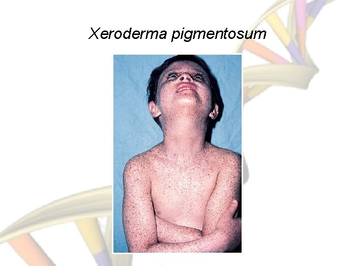 Xeroderma pigmentosum 