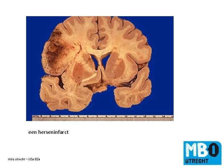 een herseninfarct mbo utrecht – UZa GZa de titel van de dia 