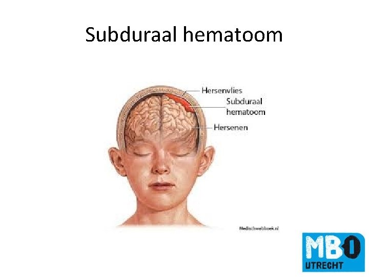 Subduraal hematoom 