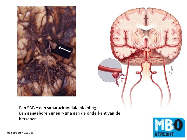 Een SAB = een subarachnoidale bloeding Een aangeboren aneurysma aan de onderkant van de