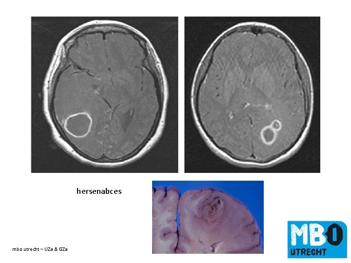 hersenabces mbo utrecht – UZa & GZa de titel van de dia 