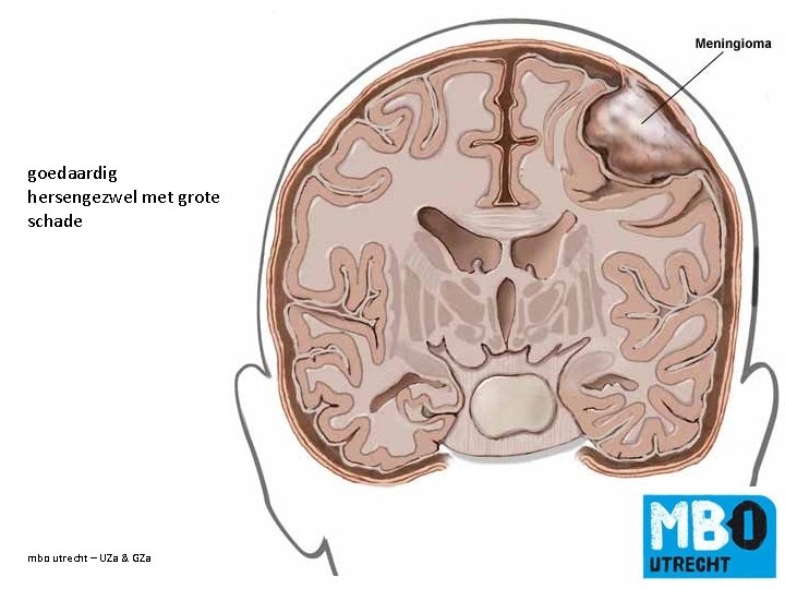 goedaardig hersengezwel met grote schade mbo utrecht – UZa & GZa de titel van