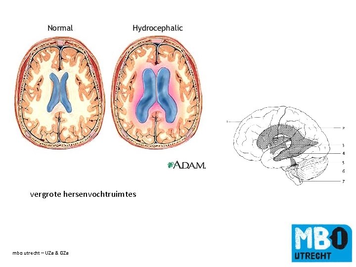 vergrote hersenvochtruimtes mbo utrecht – UZa & GZa de titel van de dia 