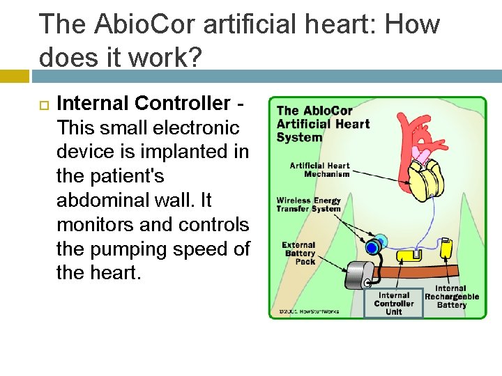 The Abio. Cor artificial heart: How does it work? Internal Controller This small electronic