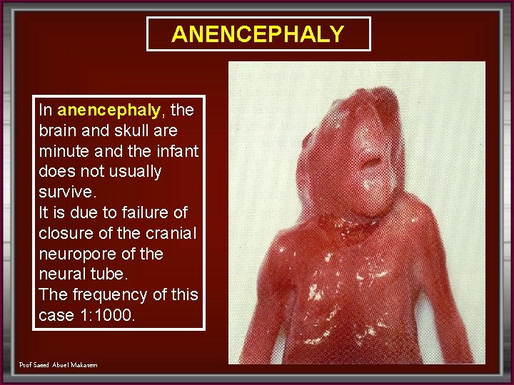 ANENCEPHALY In anencephaly, the brain and skull are minute and the infant does not