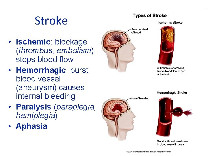 Stroke • Ischemic: blockage (thrombus, embolism) stops blood flow • Hemorrhagic: burst blood vessel