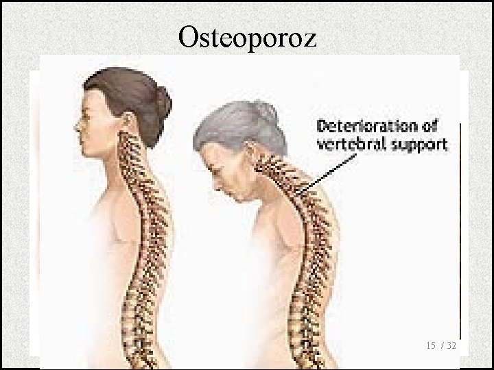 Osteoporoz 15 / 32 