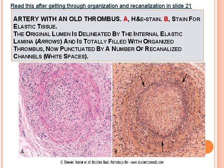 Read this after getting through organization and recanalization in slide 21 ARTERY WITH AN