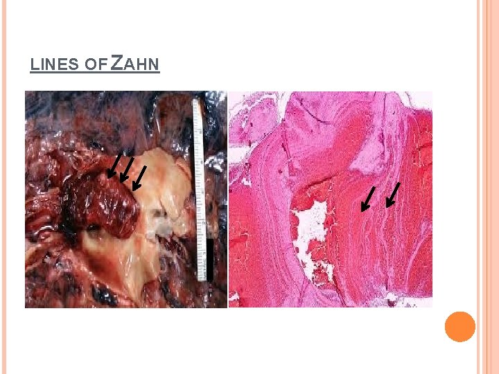 LINES OF ZAHN 
