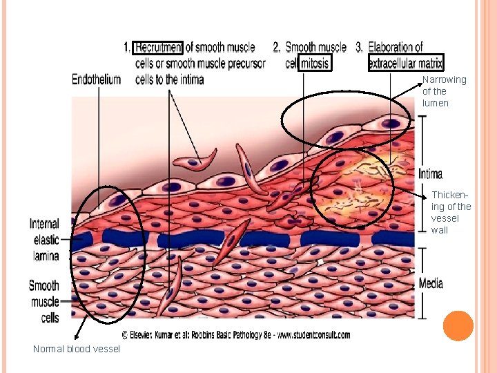 Narrowing of the lumen Thickening of the vessel wall Normal blood vessel 