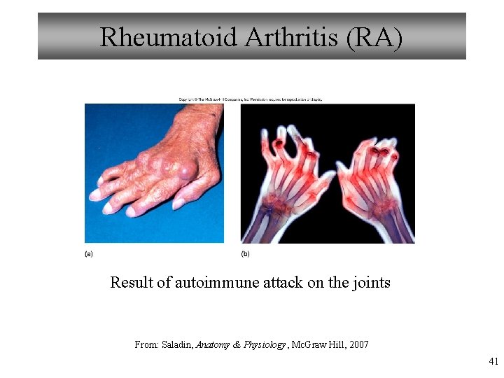 Rheumatoid Arthritis (RA) Result of autoimmune attack on the joints From: Saladin, Anatomy &