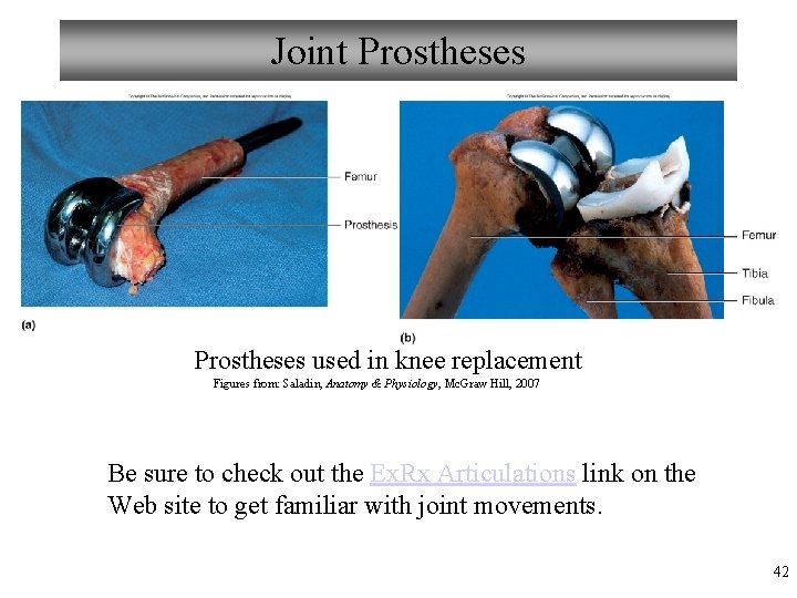 Joint Prostheses used in knee replacement Figures from: Saladin, Anatomy & Physiology, Mc. Graw