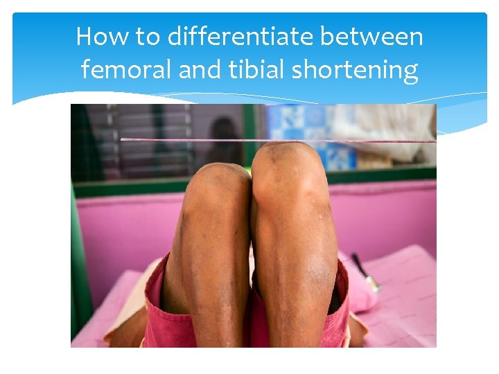 How to differentiate between femoral and tibial shortening 