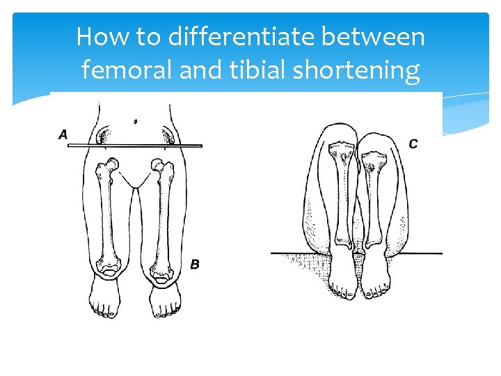 How to differentiate between femoral and tibial shortening 