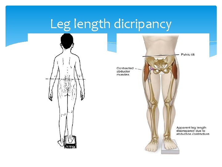 Leg length dicripancy 