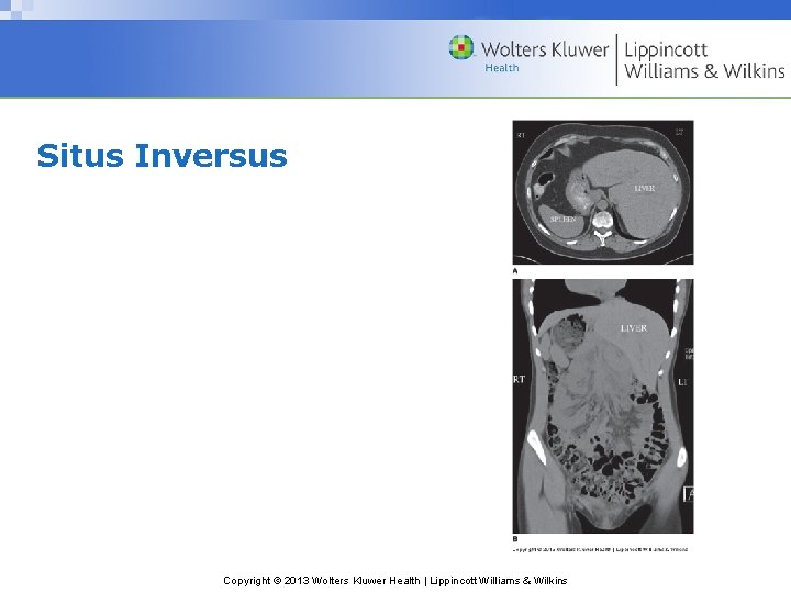 Situs Inversus Copyright © 2013 Wolters Kluwer Health | Lippincott Williams & Wilkins 